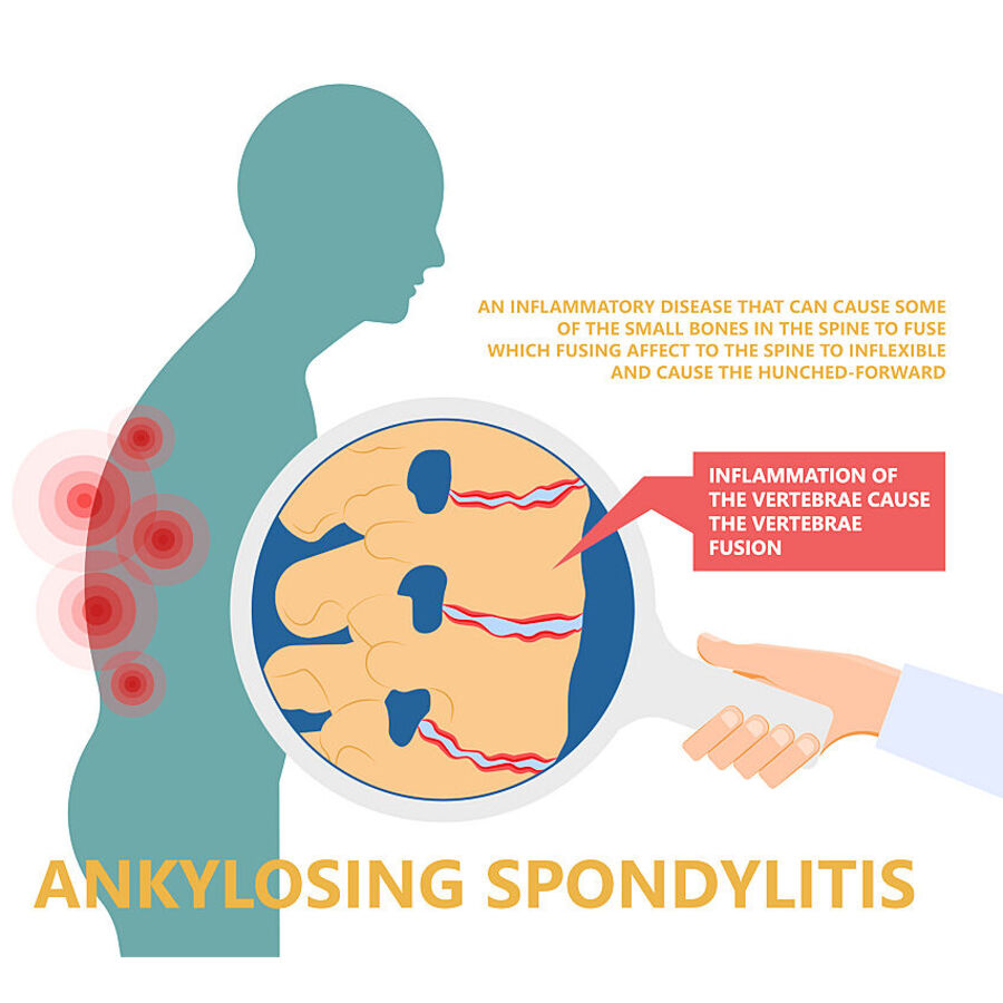 Ankylosing Spondylitis Inflammatory Disease in Spine